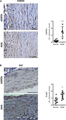 Cysteine and glycine-rich protein 3 (Crp3) as a critical regulator of elastolysis, inflammation, and smooth muscle cell apoptosis in abdominal aortic aneurysm development